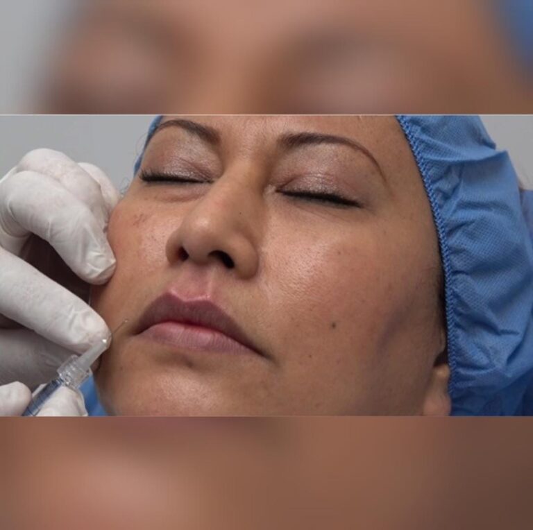 ÁCIDO HIALURÓNICO TÉCNICA CON MICRO AGUJA