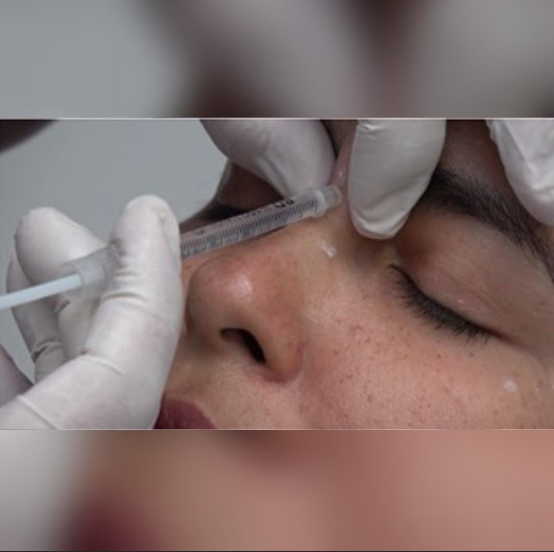 TOXINA BOTULÍNICA EN PROCEDIMIENTOS ESTÉTICOS