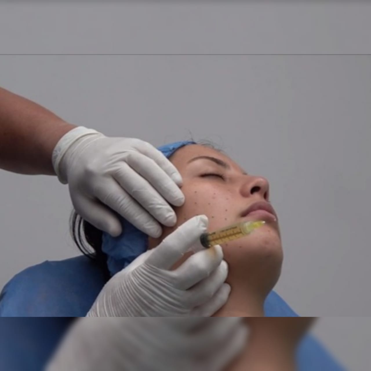 PLASMA RICO EN PLAQUETAS EN MEDICINA ESTÉTICA Y REGENERATIVA