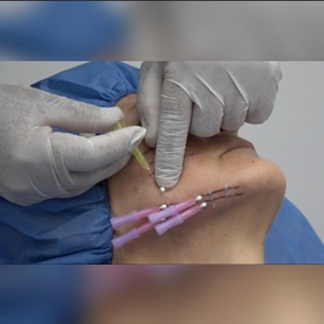 HILOS TENSORES DE DERMOSUSTENTACIÓN