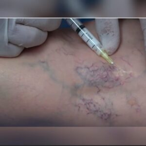 FLEBOESCLEROSIS DE VARICES EN MEDICINA ESTÉTICA