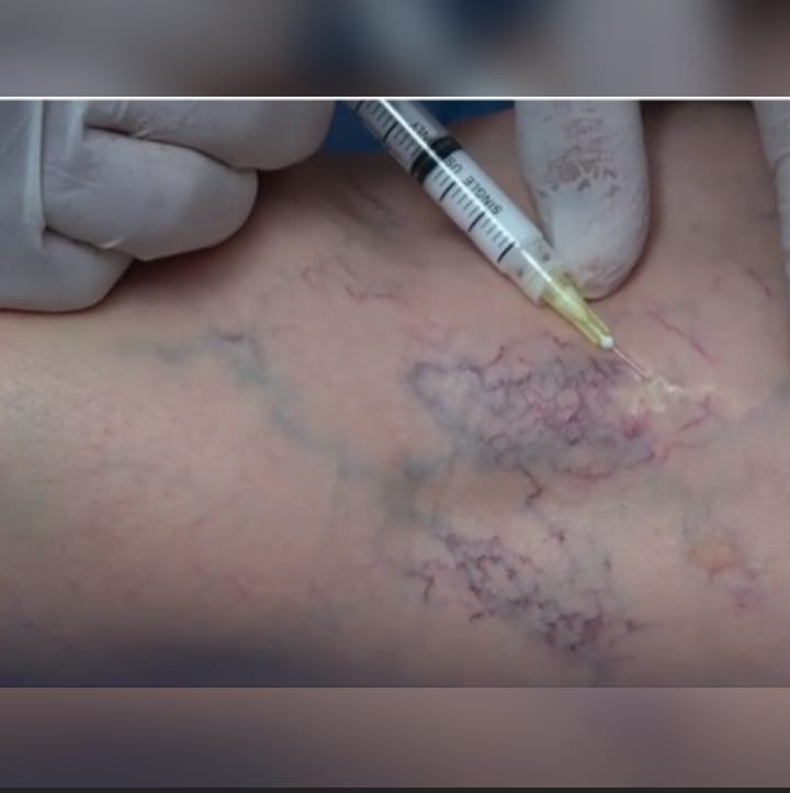 FLEBOESCLEROSIS DE VARICES EN MEDICINA ESTÉTICA